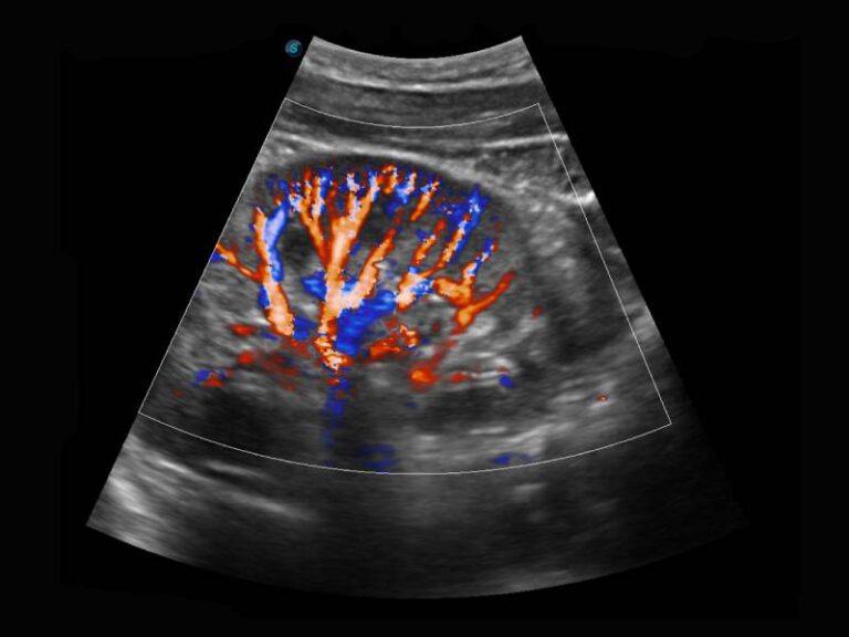 Colour Doppler | Megavision Diagnostics Centers